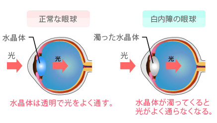 白内障（はくないしょう）