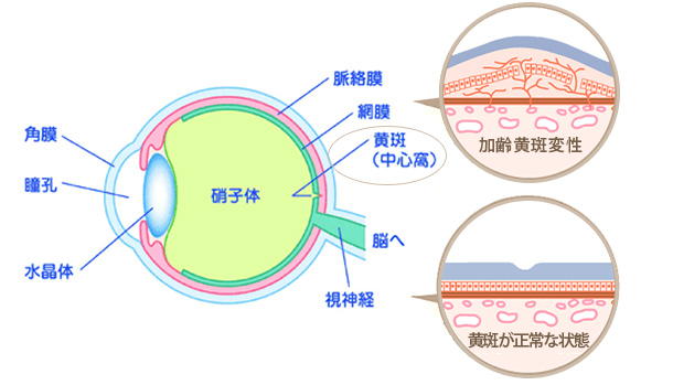 網膜剥離もうまくはくり